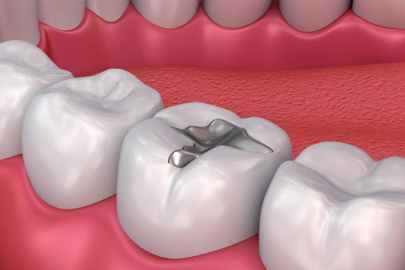 Tooth filling.jpg