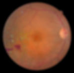 Close-up image of a human retina showing blood vessels and yellow deposits