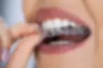 Clear aligners.webp