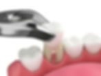 Tooth extraction.jpeg