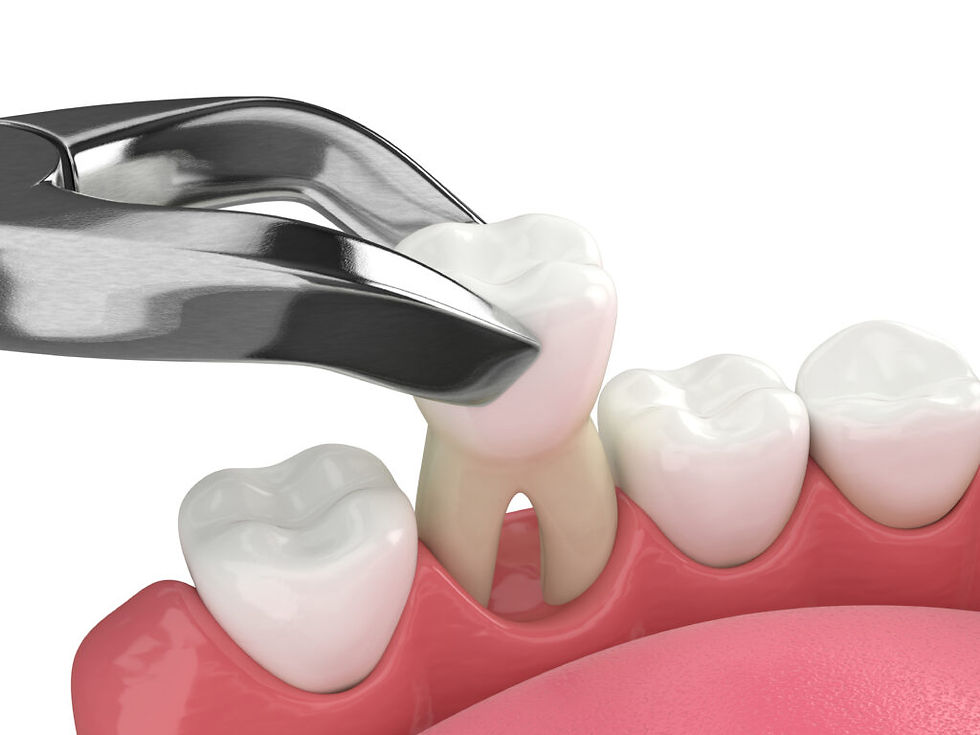 Tooth extraction.jpeg