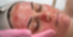 vampire-facelift-facial-at-rn-esthetics_l_1200x800.jpg