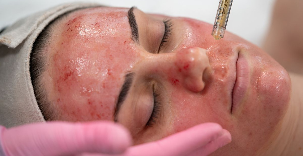 vampire-facelift-facial-at-rn-esthetics_l_1200x800.jpg