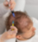 Prescriptive-Mesotherapy-725x800.jpg