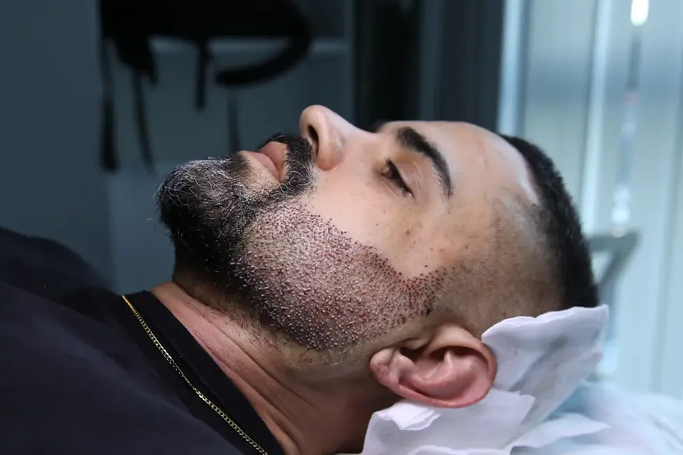 Beard-Transplant-Design-and-Planning-for-Facial-Harmony-2.webp