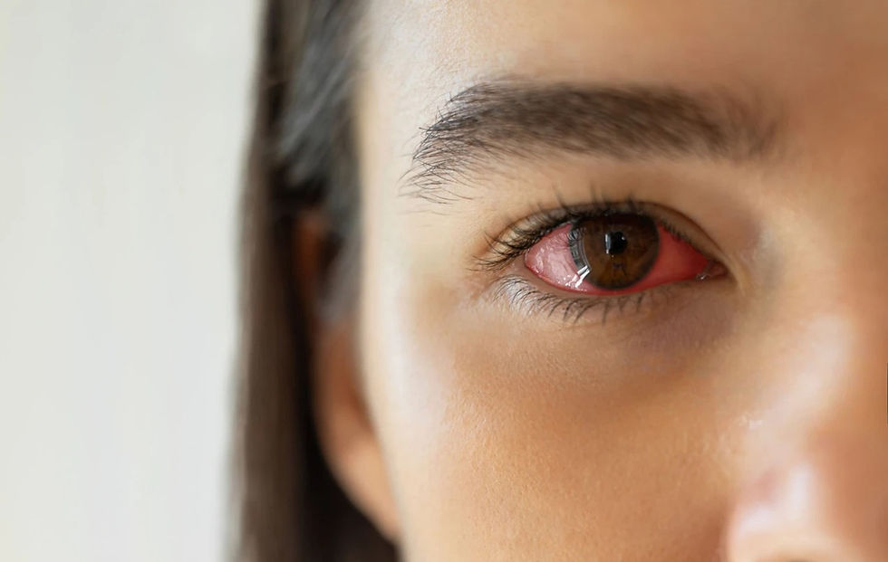 Close-up of a woman's eye with red conjunctiva, indicative of pink eye.