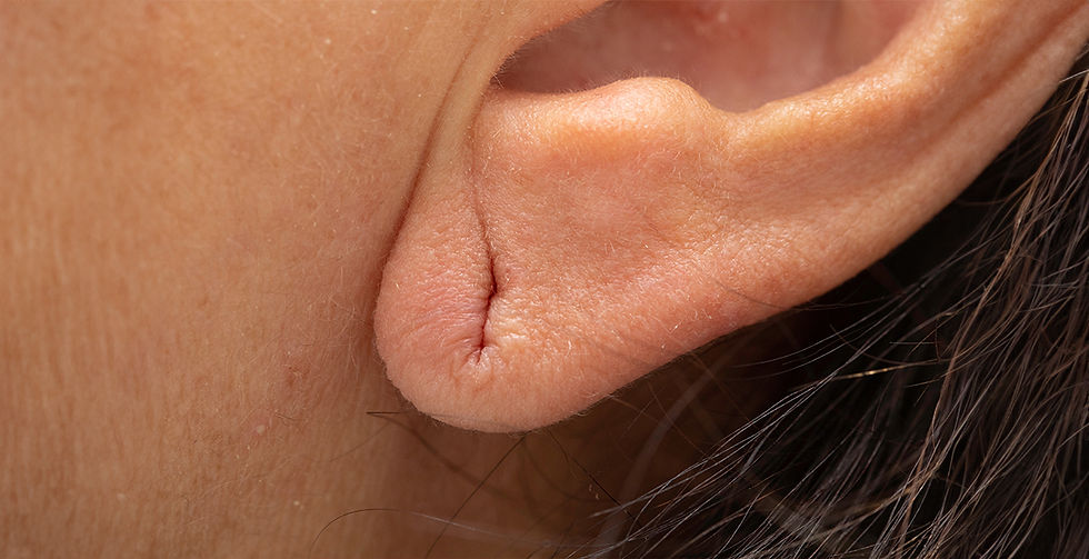 _Ear-Lobe-Repair-1.jpg