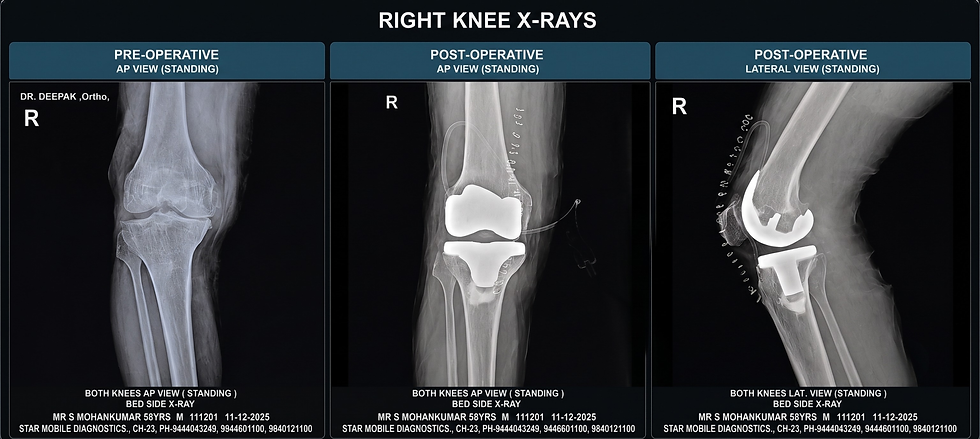 Right Total Knee Replacement for Advanced Osteoarthritis: A Patient Case Study