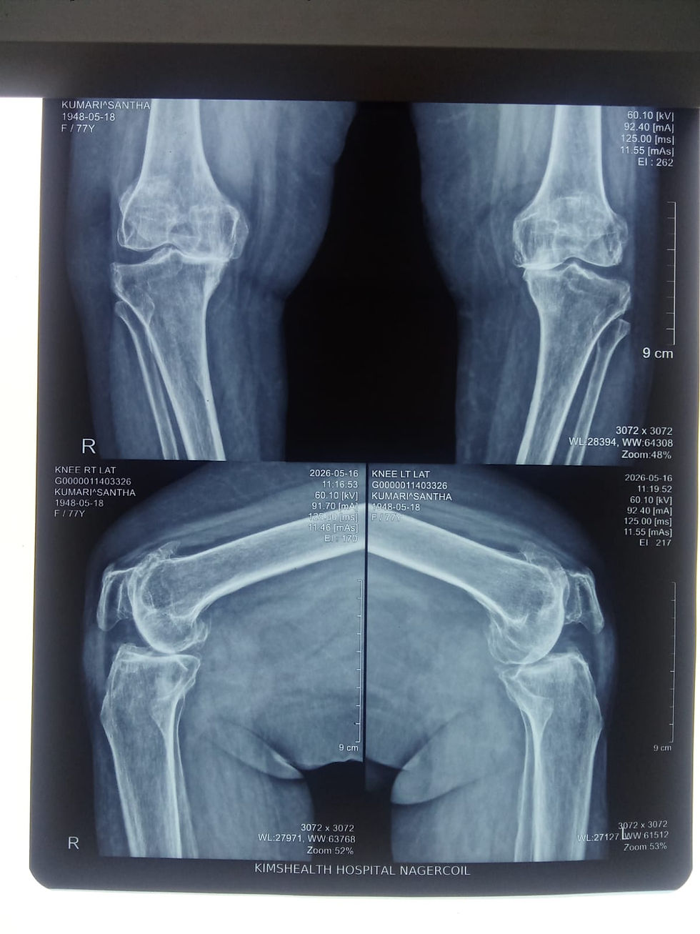 Bilateral Total Knee Replacement pre op