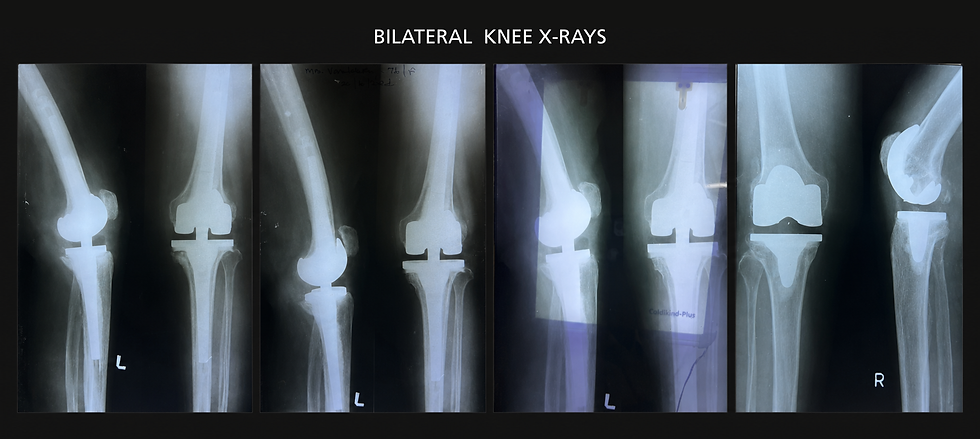 Bilateral Total Knee Replacement for Advanced Osteoarthritis
