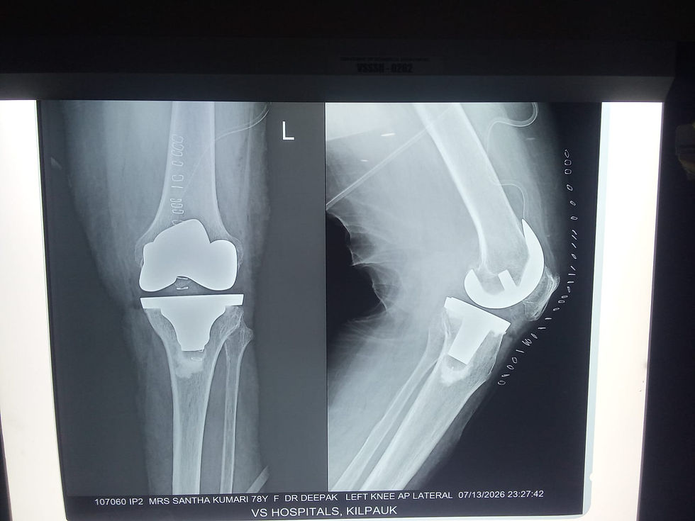 Left Total Knee Replacement for Knee Osteoarthritis