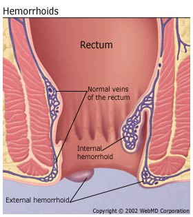 Understanding Hemorrhoids: Causes, Symptoms, and Treatment Options