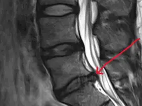The Bulging Disc on Your Scan Isn't the Whole Story: Honest Sciatica Treatment in Clyde North