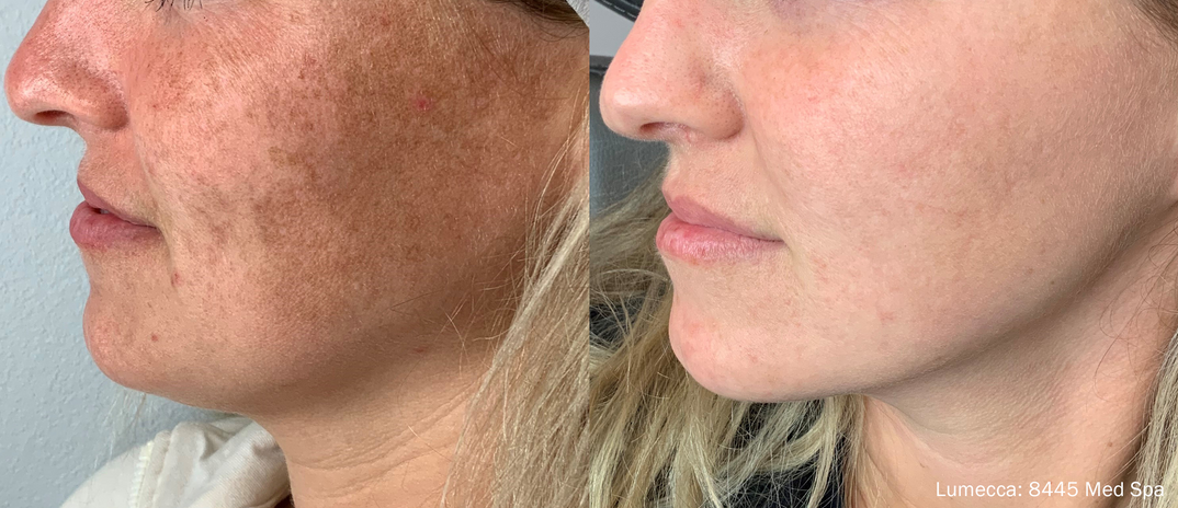Lumecca Laser Treatment Derma Dickson