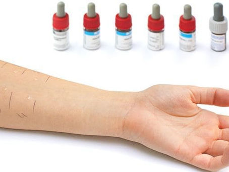 ТЕСТ чрез убождане (Prick Test)