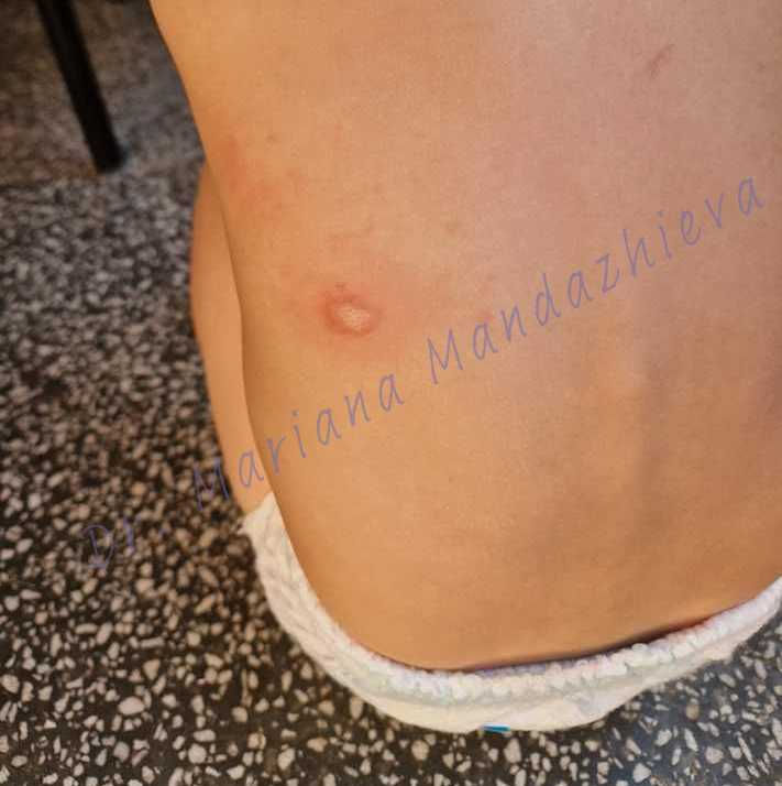 Мастоцитоза: На снимката се вижда кожната лезия (разраняване) на гърба на детето.