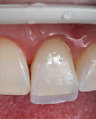 Dente com facete em resina