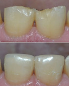 Dentes restaurados