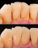 Dentes com tartáro e sem tartáro após a limpeza