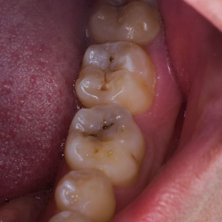 ¿Por qué es tan peligrosa la caries dental?