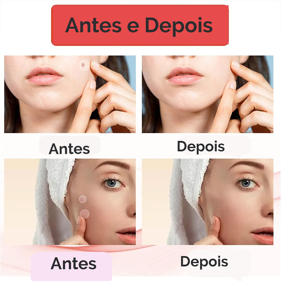 Miniatura: 144x Adesivos secativos invisíveis para acne facial,