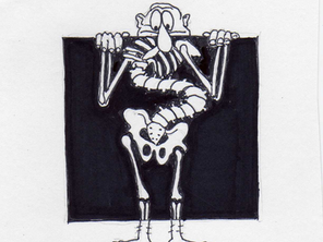 SCOLIOSIS (CURVATURE OF THE SPINE)