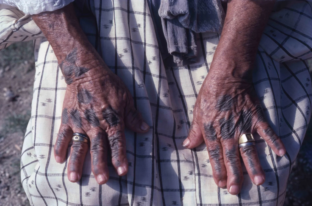 Close-up shot of a person's hands with distinct skin discoloration. The hands are positioned against a fabric backdrop of a checkered pattern in shades of white and gray. The skin on the hands is a dark brown and appears aged with visible wrinkles and a pattern of darkening specifically along the veins and knuckles. One hand features two rings on the fingers; the first ring appears to be gold and encrusted with a small jewel or similar ornate detail. The other hand has a stack of two rings, both with a silver tone. The selective dark pigmentation in the hands contrasts noticeably with the overall tone of the skin.