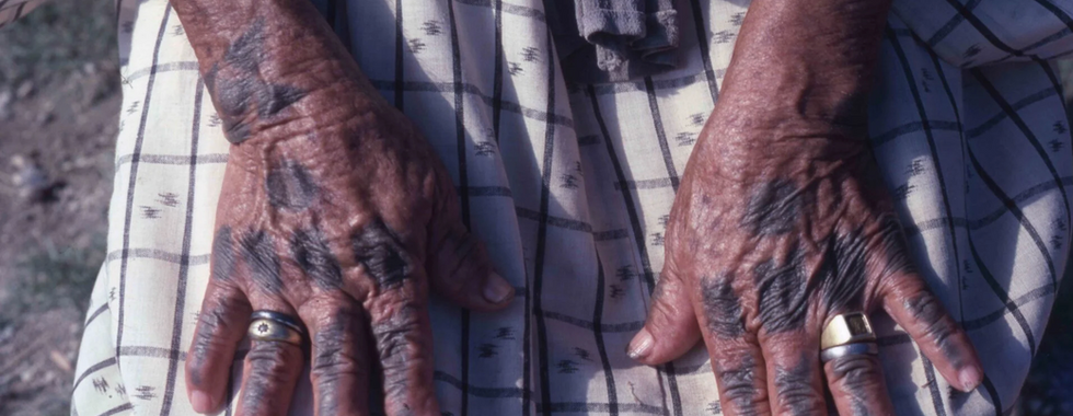 Close-up shot of a person's hands with distinct skin discoloration. The hands are positioned against a fabric backdrop of a checkered pattern in shades of white and gray. The skin on the hands is a dark brown and appears aged with visible wrinkles and a pattern of darkening specifically along the veins and knuckles. One hand features two rings on the fingers; the first ring appears to be gold and encrusted with a small jewel or similar ornate detail. The other hand has a stack of two rings, both with a silver tone. The selective dark pigmentation in the hands contrasts noticeably with the overall tone of the skin.