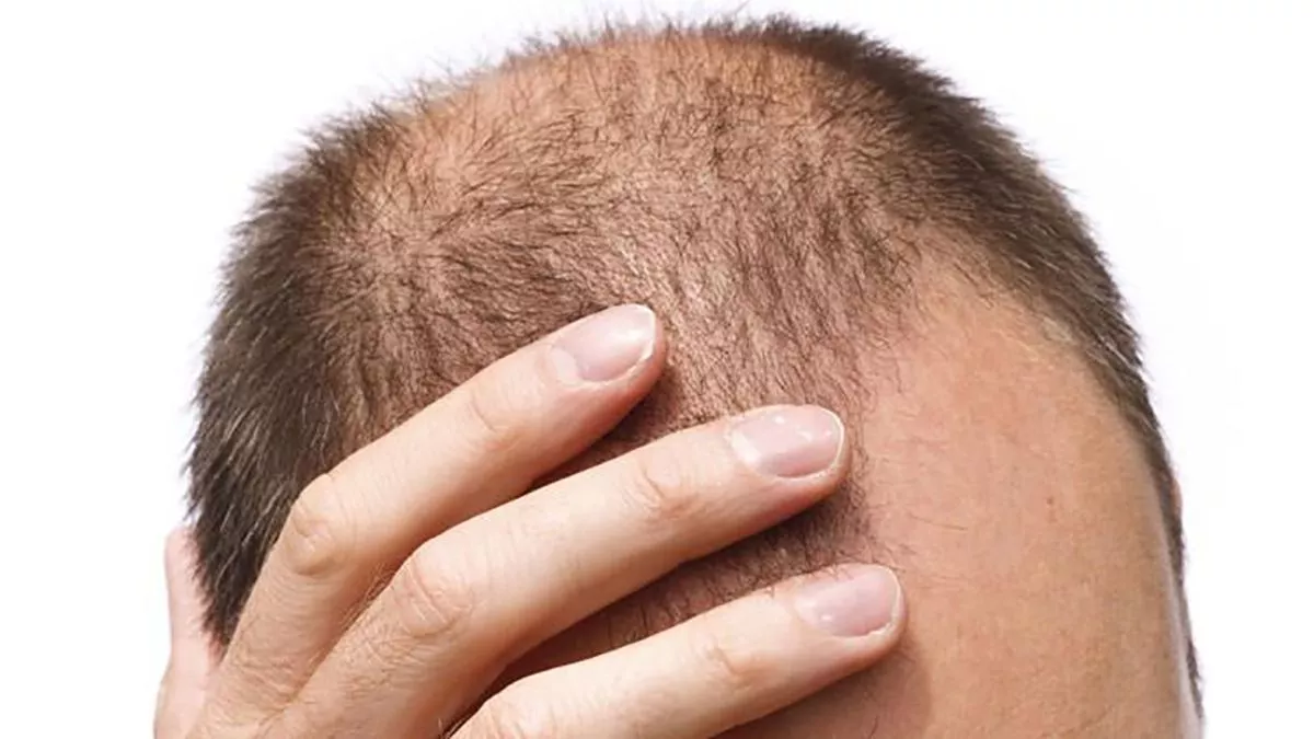 Te despiertas un día y el espejo no da el mismo reflejo de hace algunos años. Tu cabello ahora es más escaso o incluso se ha ido por completo en algunas partes, ya no piensas en cómo lo acomodarás o el peinado que mejor te queda, ahora sólo quieres ocultar el problema.