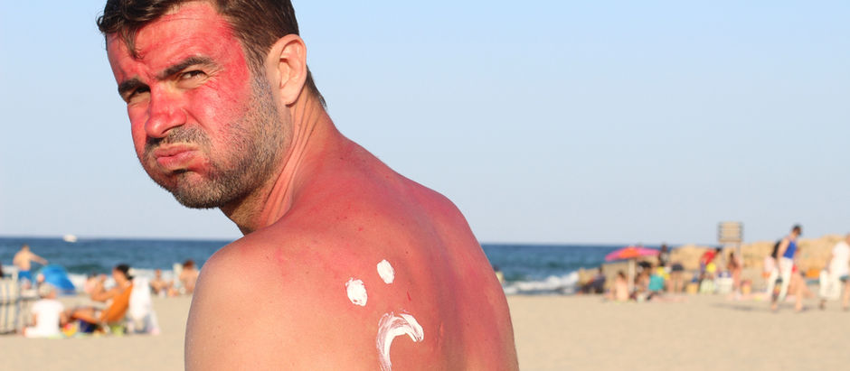 Sunburn Basics
