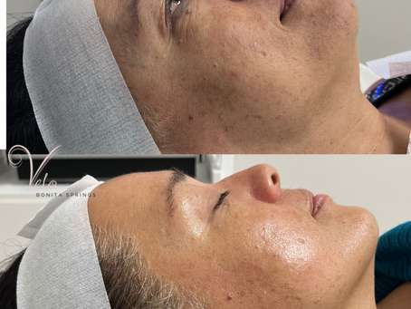 PRX & The VELO Method™: The Art of Intentional Treatment Layering