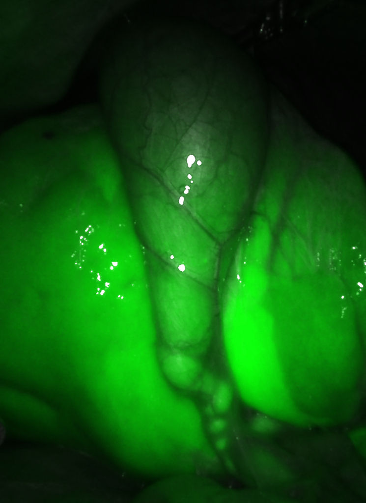 gallbladder visualized under Indocyanine Green (ICG) during robotic surgery