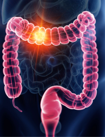 Your Guide to Colon Resections in Sarasota: From Diagnosis to Recovery
