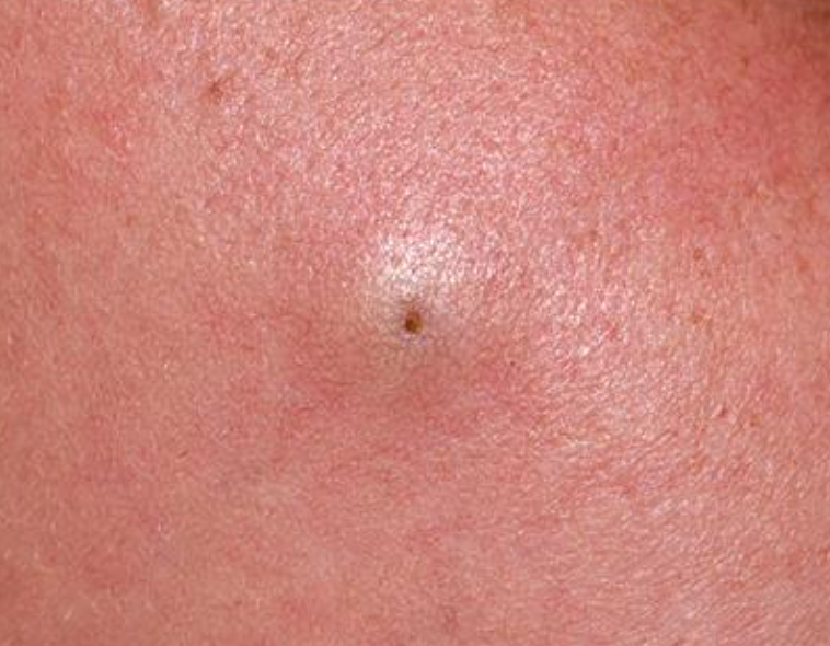 sebaceous cyst in the skin in sarasota