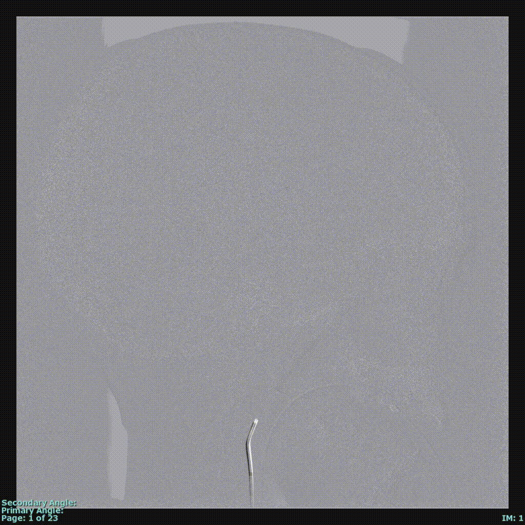 Advanced Neurovascular Imaging and Research Cerebral Profilerative Angiopathy Disease