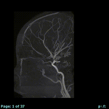 Advanced Neurovascular Imaging and Research Moyamoya Disease