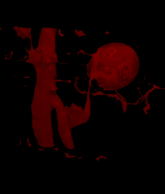 Advanced Neurovascular Imaging and Research Vein of Galen disease