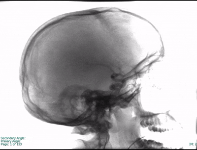 AVM Rotation.gif