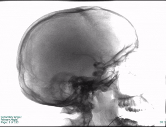 AVM Rotation.gif
