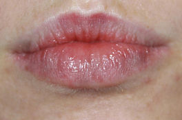 Lippenkonturierung, Lippenrand, Lippenkonturerung