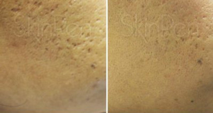 Skin pen Before-and-After-Picture-CA-3-400x435 2.jpg