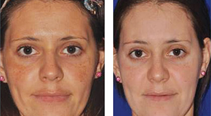 treatment center claremont skin Needling Micro