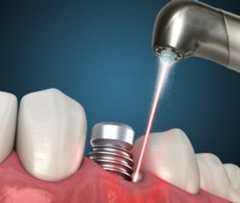 Laser-Dental-Implant-Therapy.jpg