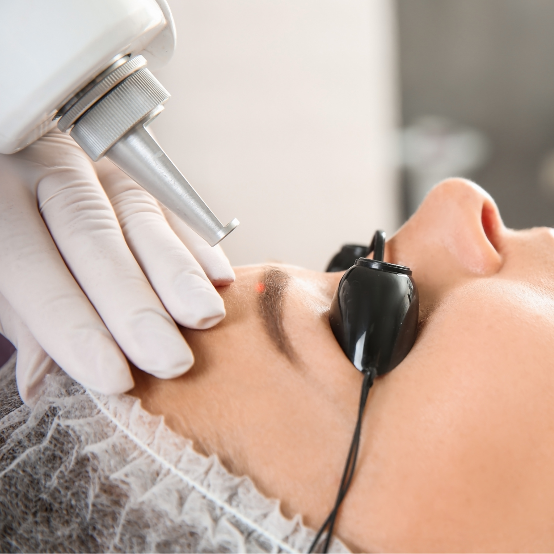 REMOÇÃO DE MICROPIGMENTAÇÃO