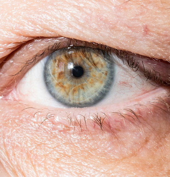 Blefaroplastia de pálpebras_2 (1).png