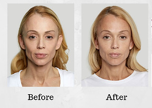 sculptra-aesthetic-before-and-after-photo1.jpg