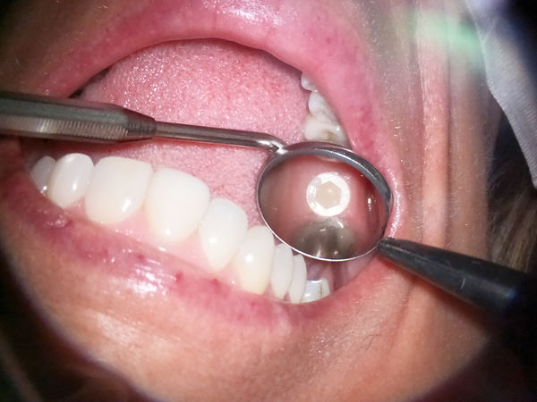Gopro Hero 11 picture 11 Dental microsco