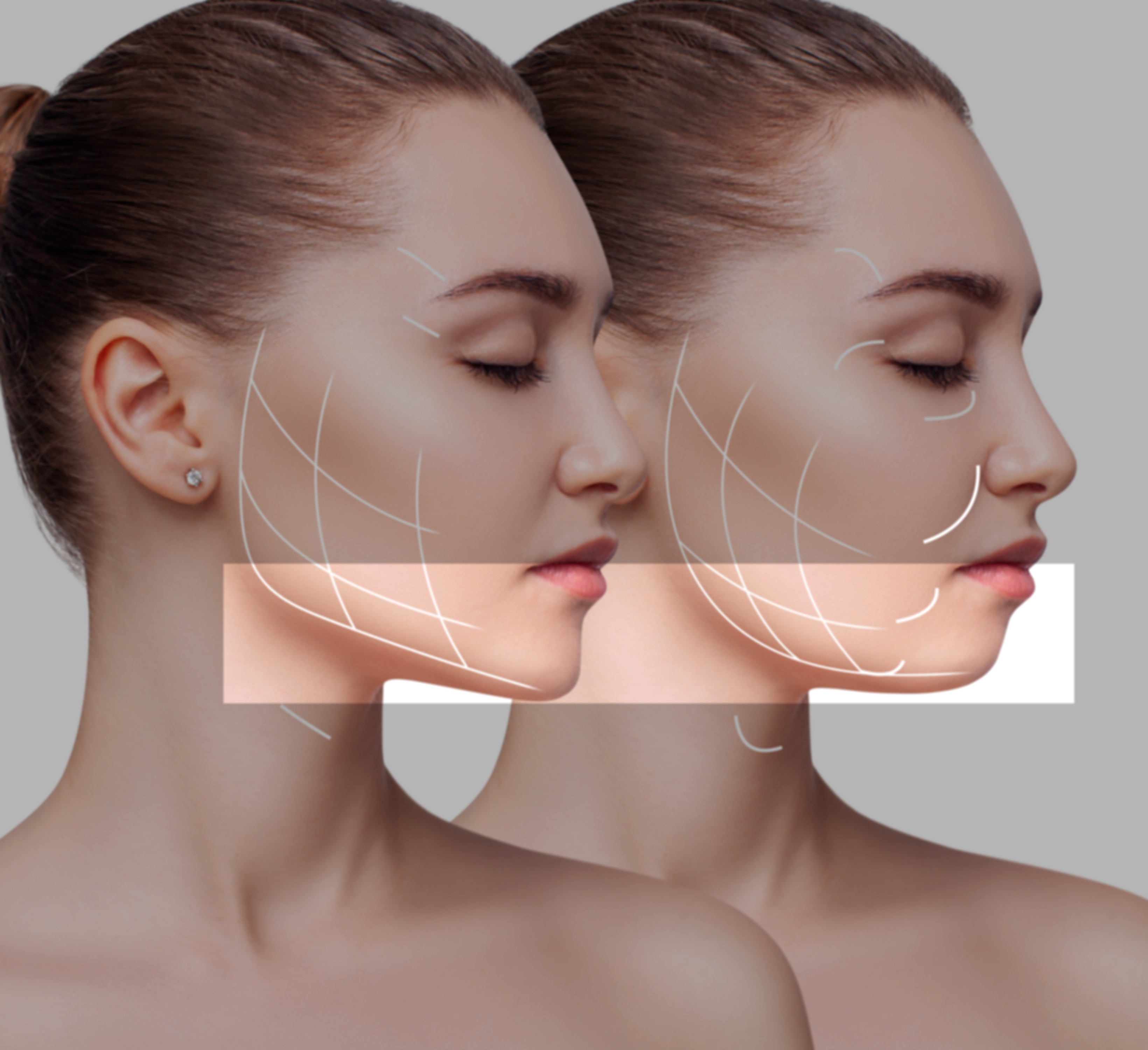 hifu linea mandibular