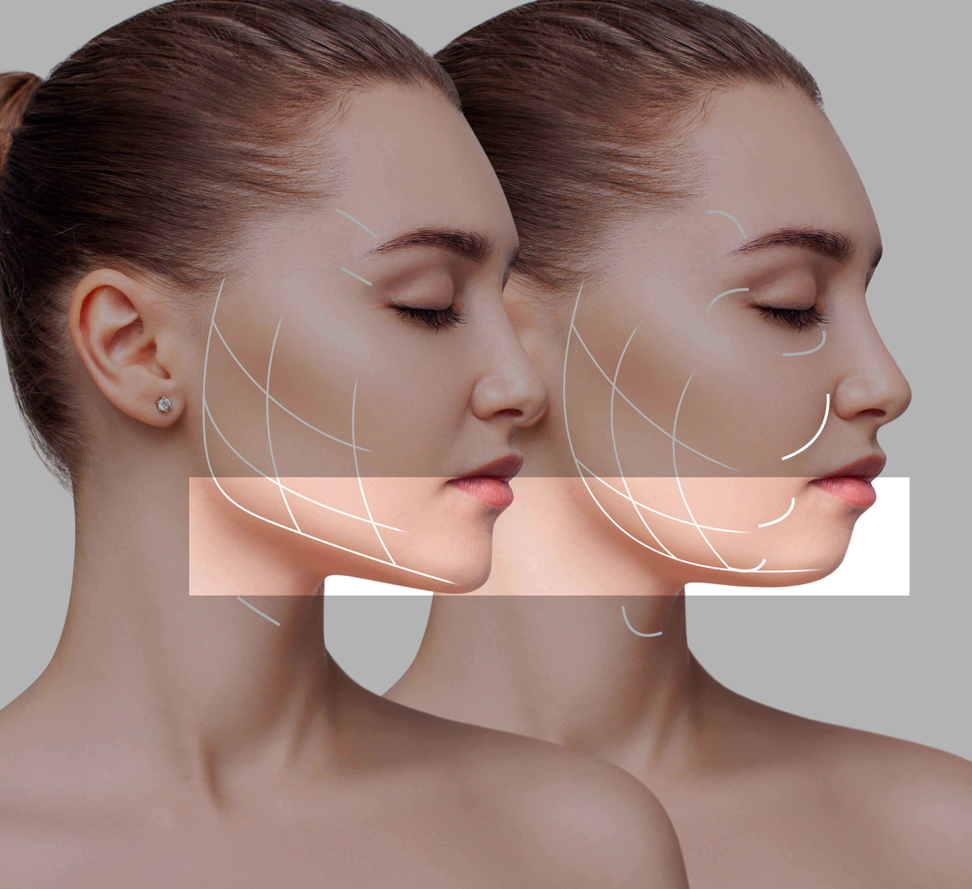 hifu linea mandibular