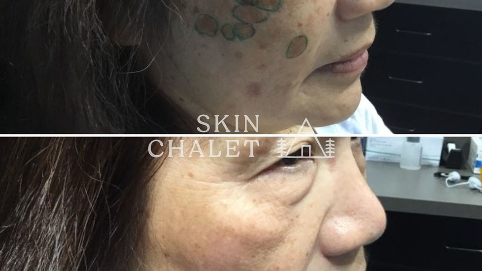 Skin Lesion Removal 